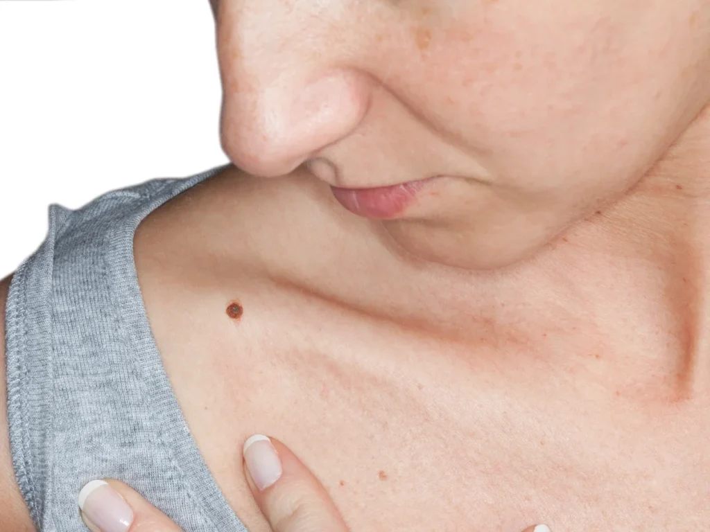 How Does CryoPen Sun Damage Treatment Wolverhampton Work? Wolverhampton