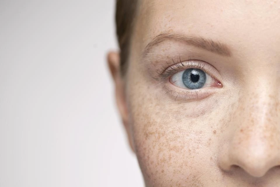 Understanding Sun Damage: How UV Rays Alter Skin and How CryoPen Can Reverse It Wolverhampton