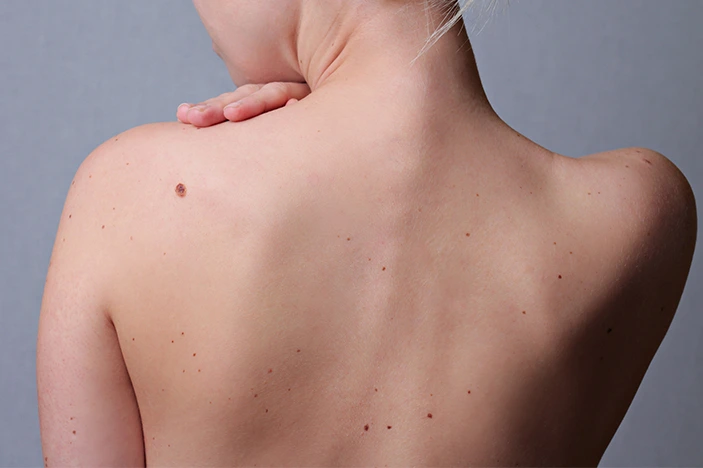 The Skin&rsquo;s Healing Journey After CryoPen Sun Damage Treatment Wolverhampton