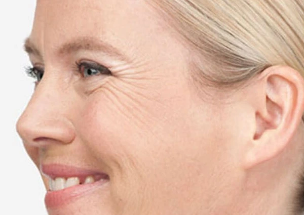 CryoPen Precision vs. Laser: Which Is Better for Sun-Damaged Skin? Wolverhampton
