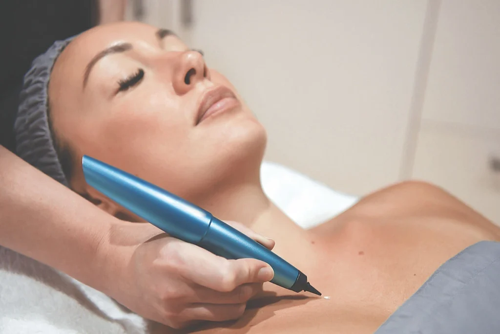 What is CryoPen Technology Wolverhampton? Wolverhampton