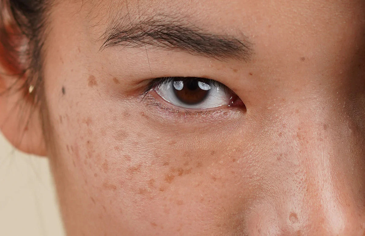 Is There Any Risk of Scarring or Pigmentation Wolverhampton? Wolverhampton
