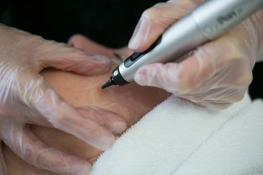 The CryoPen Technology Explained: How Extreme Cold Removes Sun-Damaged Skin Cells Wolverhampton
