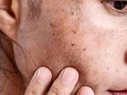 Why CryoPen Works Best for Isolated Sun Spots and Pigmentation Wolverhampton