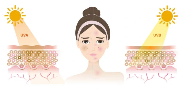 Understanding Sun Damage Wolverhampton : How Do UV Rays Cause Changes in the Skin? Wolverhampton