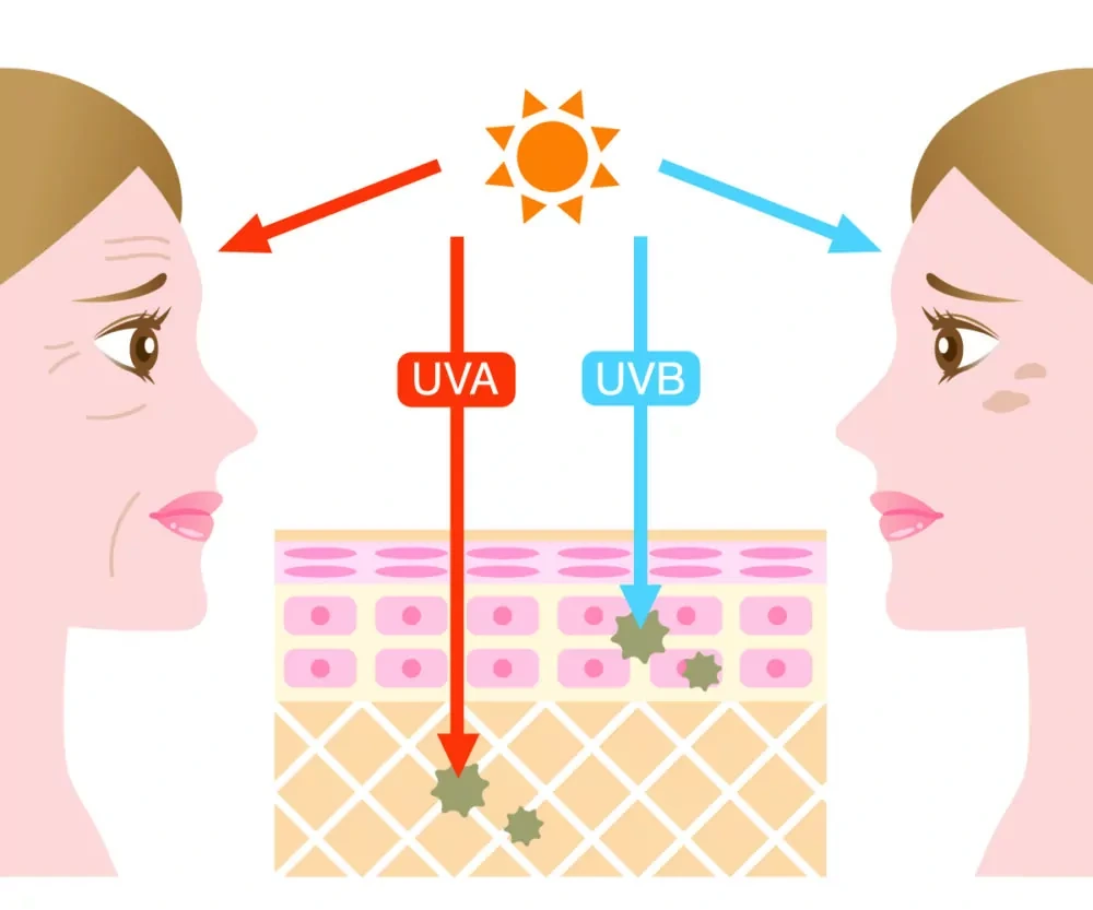 Understanding Sun Damage Wolverhampton - Why Should Sun Damage Be Treated Early? Wolverhampton